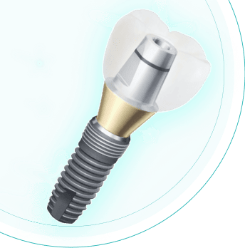 Установка импланта Dentium под ключ