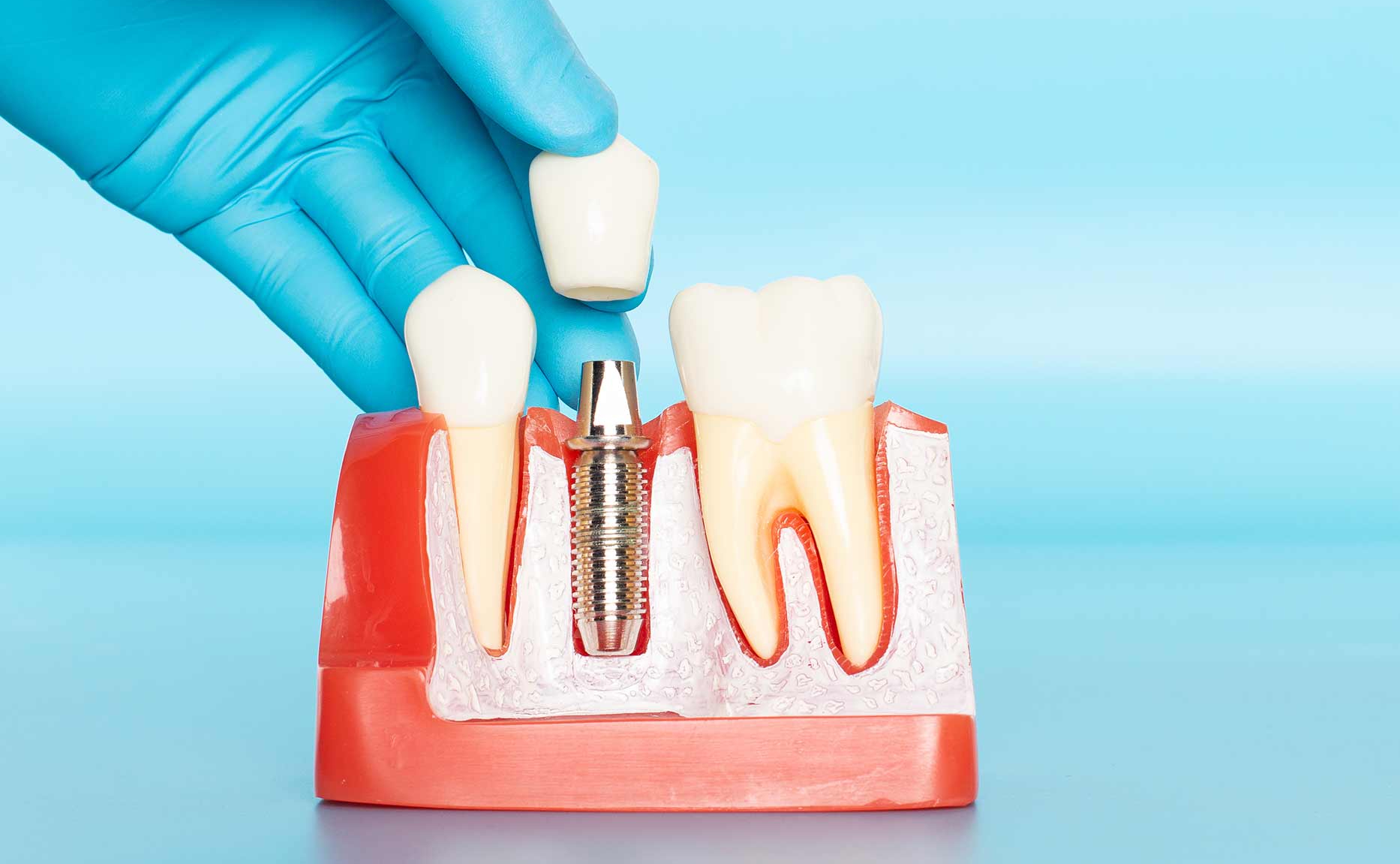 Рейтинг зубных имплантов: какие импланты лучше ставить и как выбрать