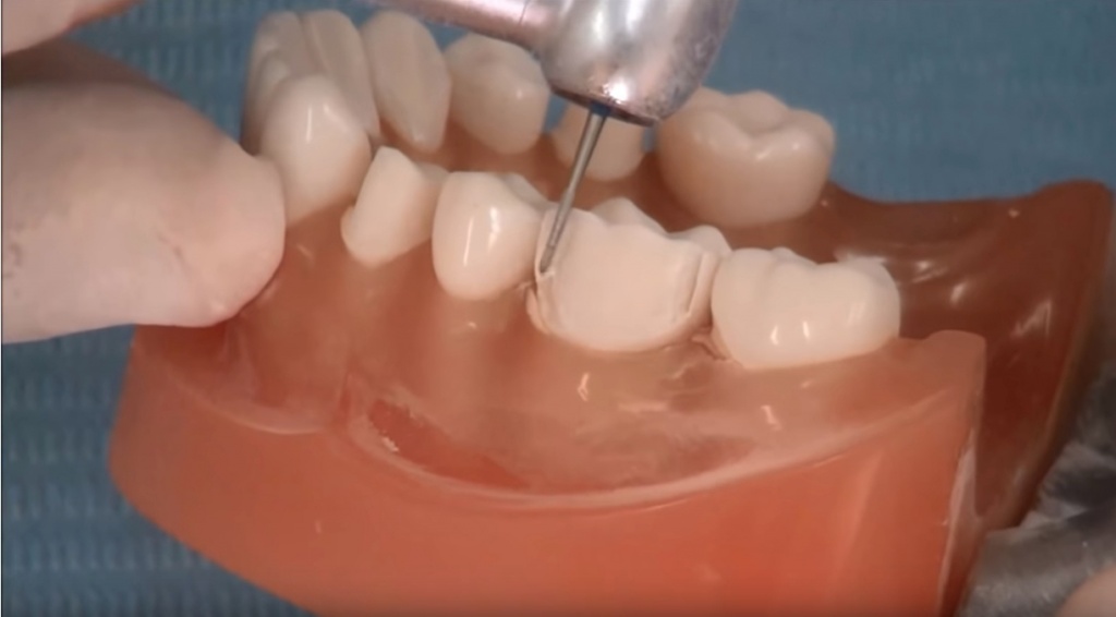 Препарация зуба под металлокерамическую коронку
