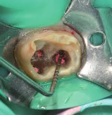 реставрация зубов на приеме