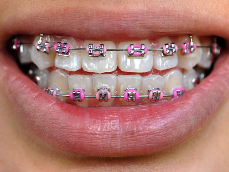 types-of-braces.jpg
