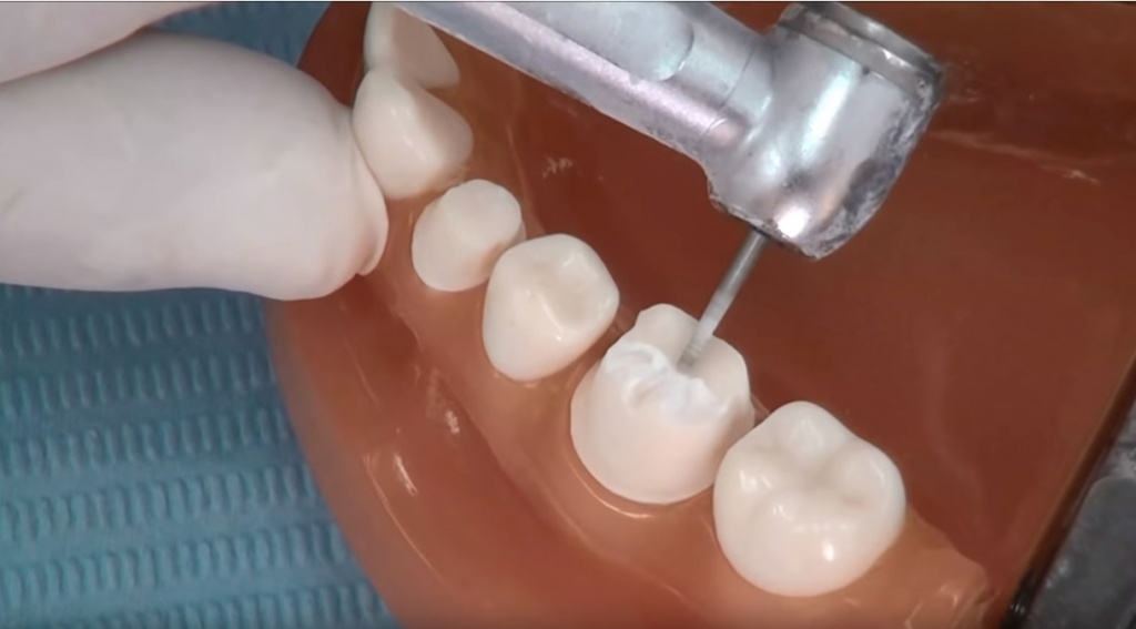 Препарирование зуба под металлокерамику