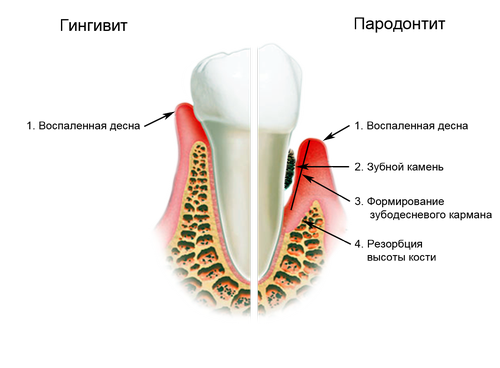parodontit-gingiovit.png