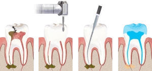удаление корня зуба