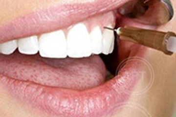 Лечение воспаления корня зуба