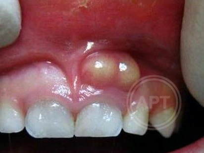 Прыщ на десне - полезные статьи стоматологической сферы в блоге «Гелиоса».