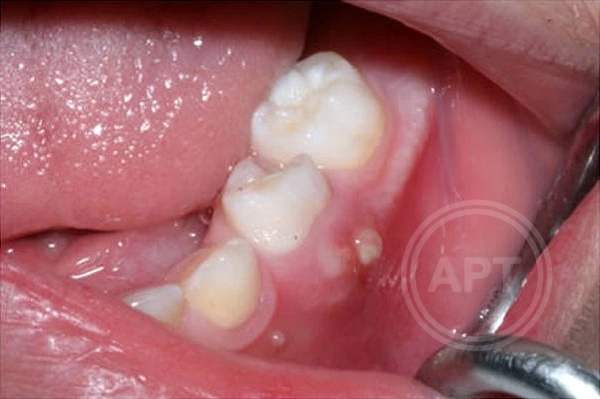 Что делать, если опухла (воспалилась) десна возле зуба и болит, отдавая в зубы?