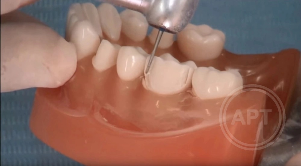 Препарация зуба под металлокерамическую коронку