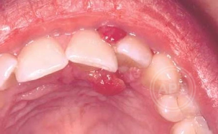 Удаление и лечение кисты зуба в СПб [симптомы, методы и цены лечения]
