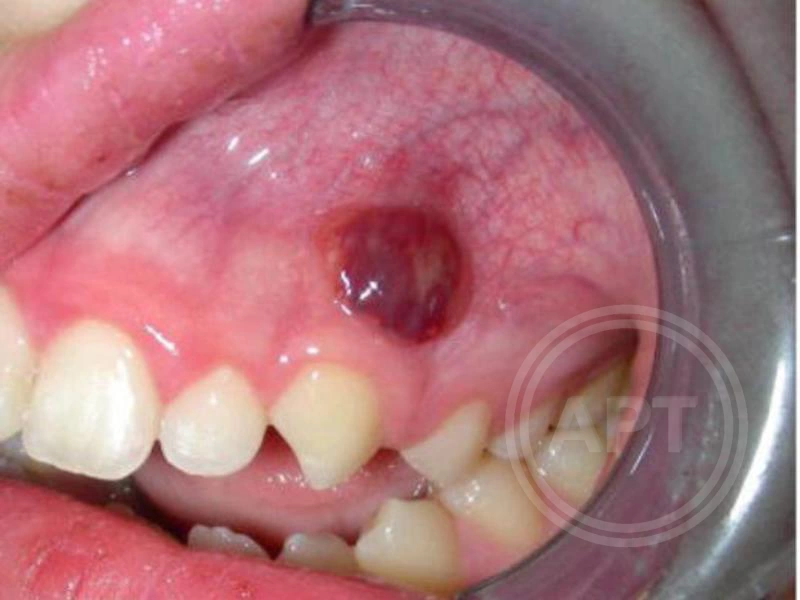 Гипоплазия эмали молочных зубов: условия возникновения, лечение, профилактика