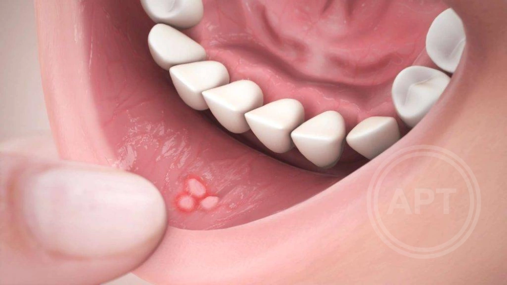 Язвы в полости рта - «Стоматология на Марата 31»