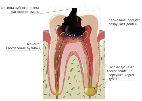 Четвертый канал в зубе или откуда берется киста? - блог стоматолога TopSmile