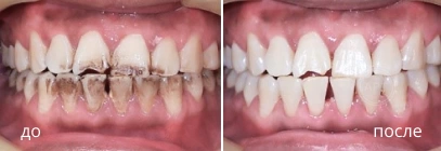 Фото до и после профессиональной чистки зубов