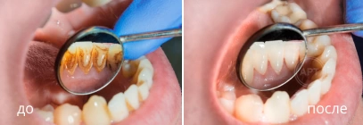 Фото до и после профессиональной чистки зубов
