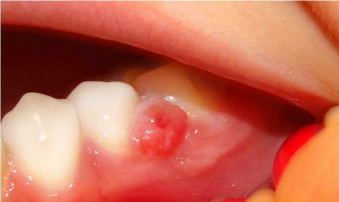 расположение кисты зуба