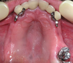 Бюгельное протезирование зубов 
