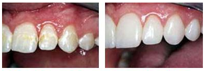 Фторирование зубов - до и после