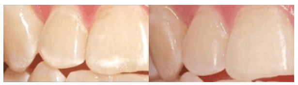 Фторирование зубов - до и после