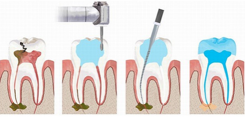 Как проходит лечение каналов зуба