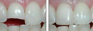 Прямая реставрация зуба