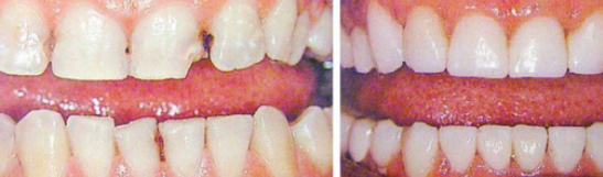 Реставрация разрушенных зубов