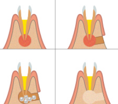Зубосохраняющие процедуры
