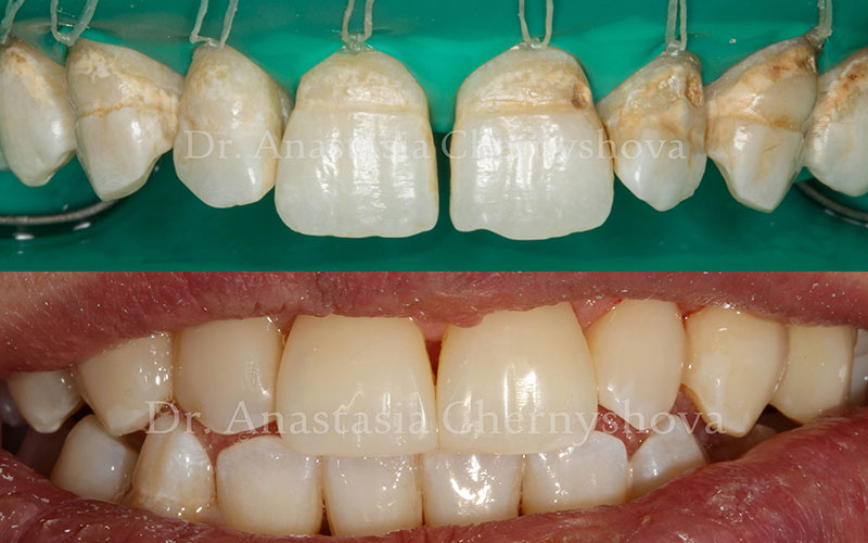 Лечение фронтальной группы зубов