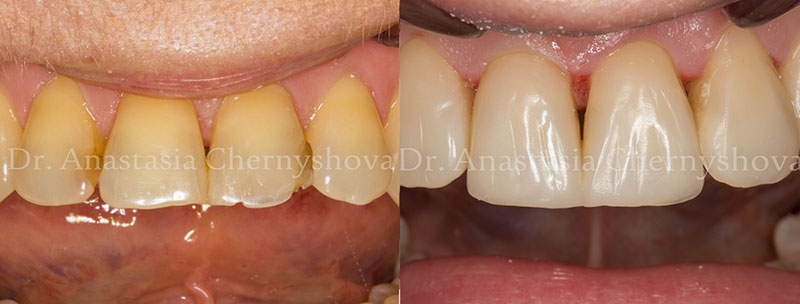 Реставрация фронтальной группы зубов