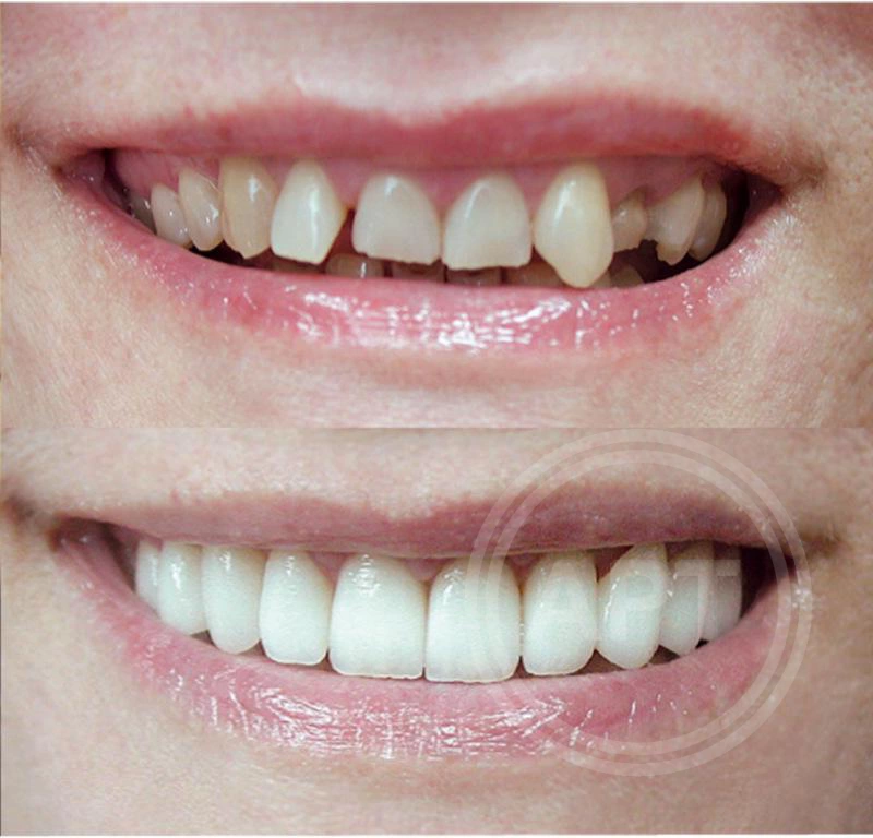 Реставрация зубов в Одинцово