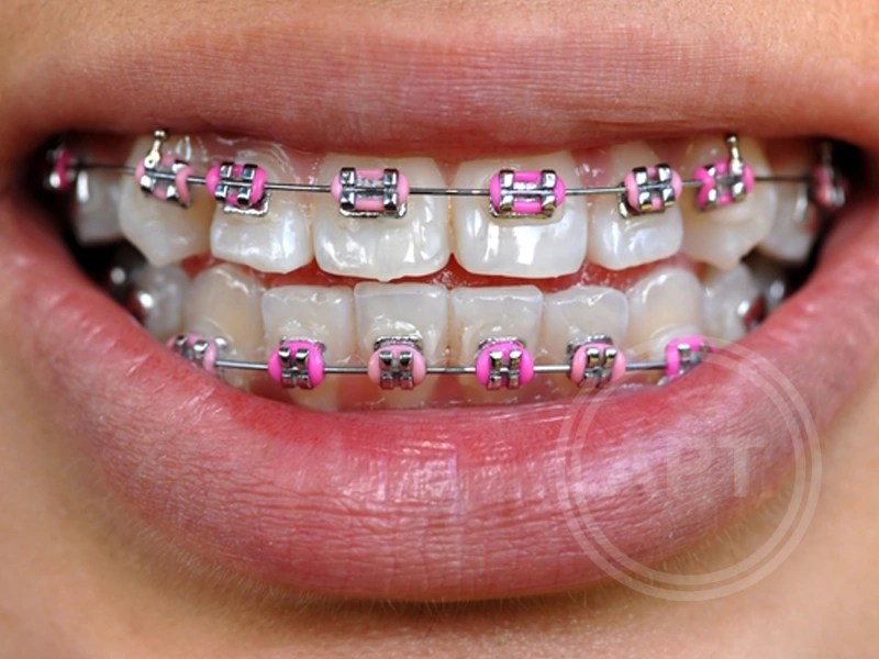 types-of-braces.jpg