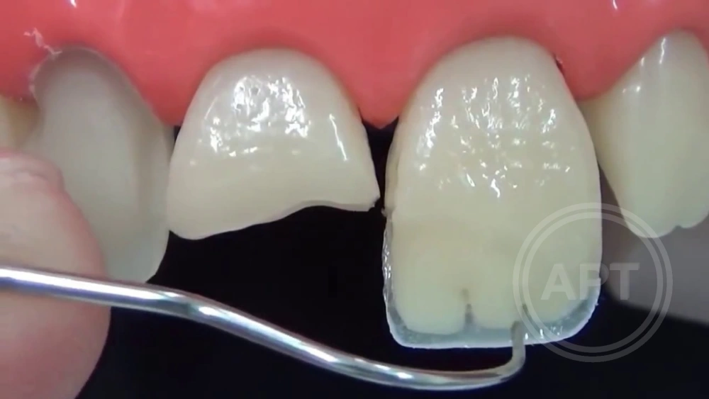 Прямая реставрация переднего зуба