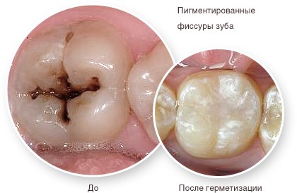герметизация фиссур зубов
